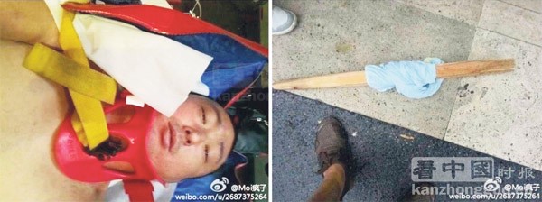 被打的姚先生颈部带着颈椎固定器 被打的姚先生颈部带着颈椎固定器