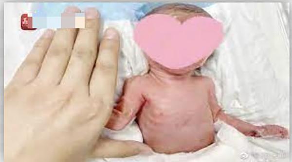 江苏省南通市一名孕妇怀孕26周生下一名“巴掌婴儿”，体重只有0.9公斤。（视频截图）