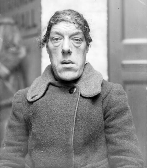 Mary得怪病后容貌变丑。(维基百科)