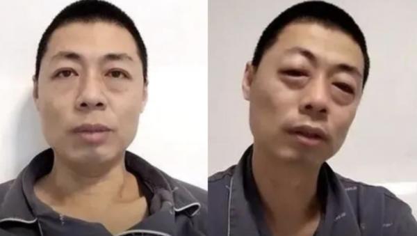 河北男子在染疫后,原本一脸帅相,拥有大眼睛双眼皮的他,痛到哭得眼肿仅剩一条线。(图片来源:微博截图)