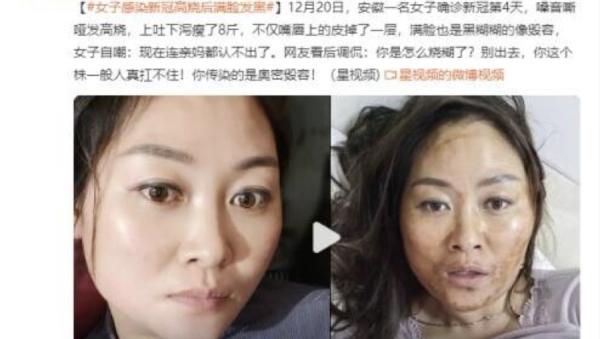 安徽一名女子将自己染疫前后的照片上载微博。(图片来源:微博截图)