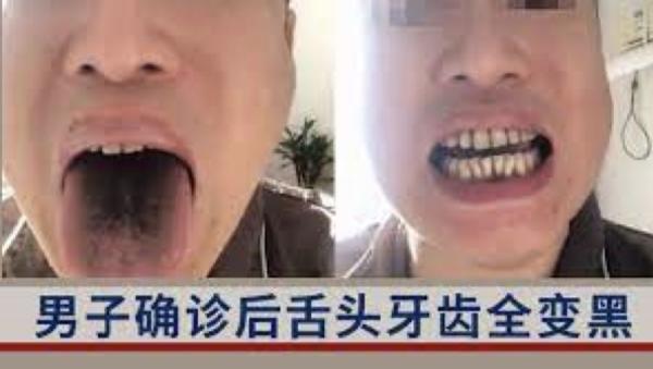 微博上,有人惊爆染疫后出现舌头发黑。(图片来源:视频截图)