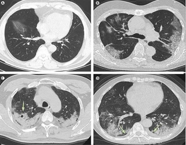 中国大陆疫情大爆发,民众纷纷亮出自己或亲人感染新冠肺炎的白肺照片。 医师 : 患者性命堪忧。(图片来源:微博)