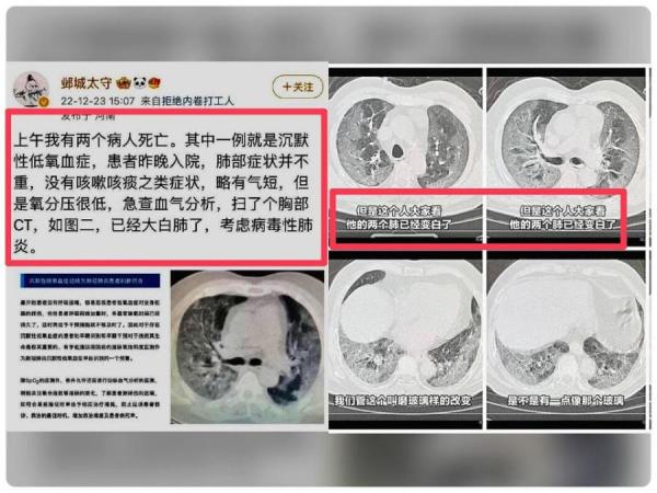 中国大陆疫情大爆发,民众纷纷亮出自己或亲人感染新冠肺炎的白肺照片。 医师 : 患者性命堪忧。(图片来源:微博)