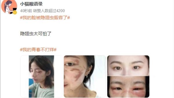 早于今年6月,大陆网络社交平台曾出现一则“我的脸被隐翅虫毁容了”的消息,并吸引183万人热议。(图片来源:微博)