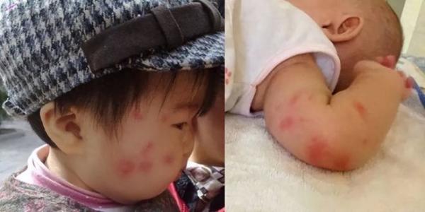 近期河南、山东、四川等多个省市又有不少民众发现了“隐翅虫”。(图片来源:网络图片)