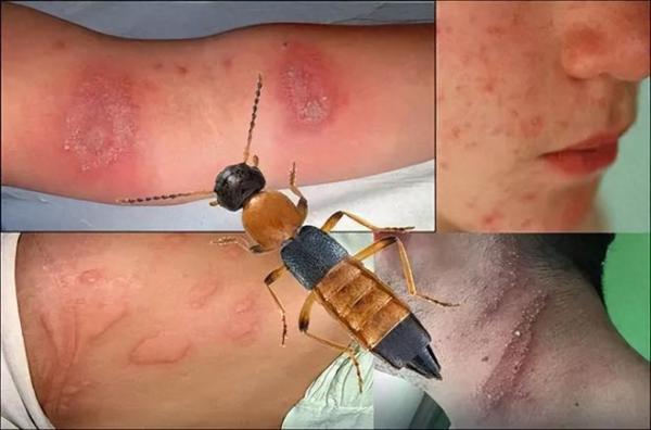 近期河南、山东、四川等多个省市又有不少民众发现了“隐翅虫”(图片来源:微博截图)