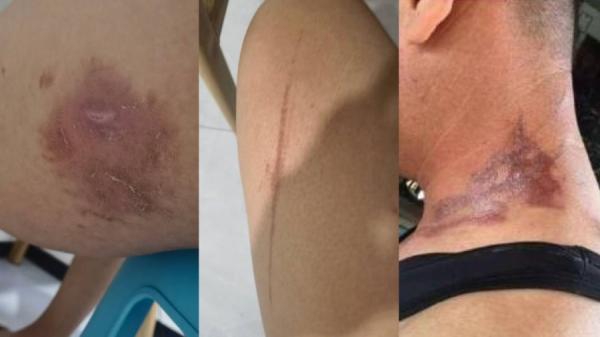 近期河南、山东、四川等多个省市又有不少民众发现了“隐翅虫”(图片来源:微博截图)