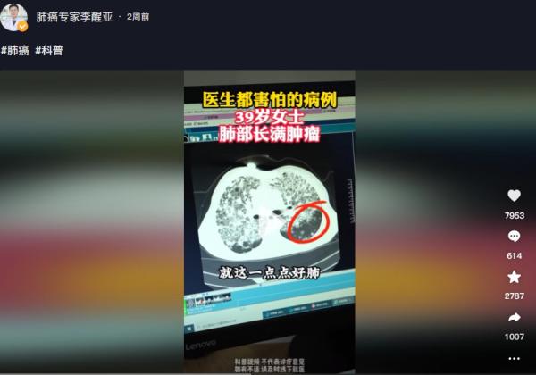 一名39岁女士肺部长满肿瘤。(图片来源:抖音截图)
