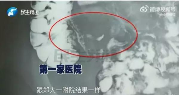 吕先生带儿子去两家医院检查,结果都显示 “ 阑尾可见 ”。(图片来源:视频截图)