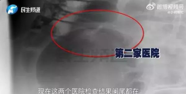 吕先生带儿子去两家医院检查,结果都显示“阑尾可见”。(图片来源:视频截图) 【看中国2024年4月8日讯】5年前切除的阑尾如今又长回身体里了?河南许昌吕先生12岁儿2019年右下腹疼痛,医院诊断急性阑尾炎并切除4.5cm阑尾,但术后孩子腹部仍隐隐作痛,2023年9月及今年3月,吕先生分别带儿子前往郑州、上海检查,结果竟然发现阑尾“仍在”,这让全家感到震惊,质疑医院作假或有疏失。相关消息成为7日热搜话题。 《钱江晚报》报导,根据吕先生反映,儿子2019年就诊断出急性阑尾炎,当时手术报告显示阑尾切除术顺利,送检4.5cm阑尾,没想到手术后孩子腹部一直隐隐作痛,直到去年,吕先生带着孩子前往郑州检查,报告显示阑尾显示清晰,对此全家都很震惊,“不是早都切了吗?当时切了什么?孩子几年来一直疼痛,和阑尾炎有关?” 12岁男孩 阑尾炎 吕先生带儿子去两家医院检查,结果都显示“阑尾可见”。(图片来源:视频截图) 对此,先前动手术的长葛人民医院回应,有手术记录,医学影像只是技术,如果有器官套叠就会有这种情况。但吕先生不认可,今年3月带孩子去上海仁济再次检查,仍显示阑尾可见。 根据网络影片显示,一名医院工作人员在回应吕先生及