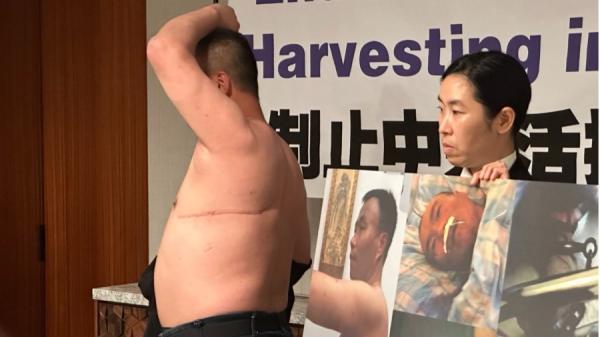 2024年7月3日,来自中国大陆的法轮功学员程佩明在美国首都华盛顿举办的记者会上,向现场记者展示了被活摘器官时上身左侧被缝合的刀口。(看中国摄)