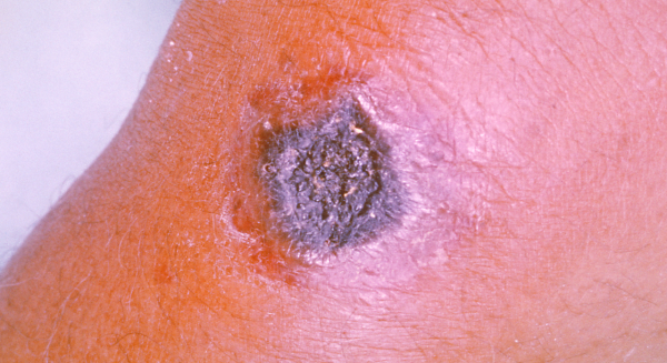 炭疽病造成的皮肤病变。(图片来源:维基百科)