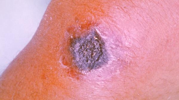 近日爆出山东聊城市阳谷县七级镇一肉牛养殖场发现炭疽病例。示意图。(图片来源:维基百科)