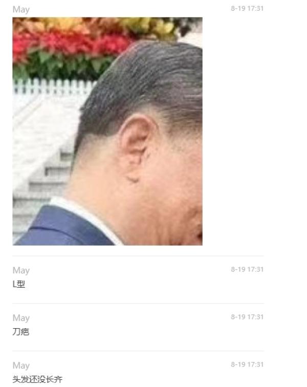 习近平头部右下方一块脱发区域,似是刚做完开颅手术,头发未长齐。(网络图片)